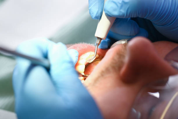 Best Emergency Tooth Extraction in Vanceburg, KY